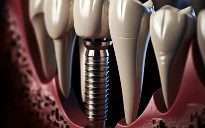 Dental Implants: Addressing Tooth Loss from Periodontal Disease and Their Vital Role in Dental Restoration