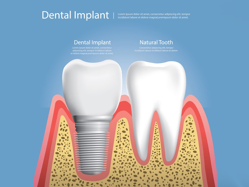 implant