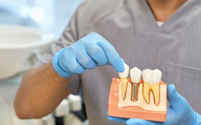 Implants dentaires : Tout ce qu’il faut savoir