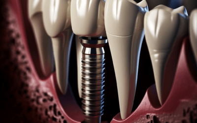Conséquences de la perte d’une dent due à une maladie parodontale et l’importance des implants dentaires